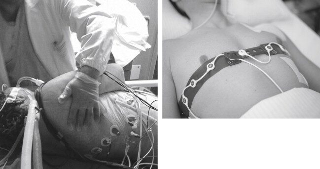 Separate electrodes versus electrode belt