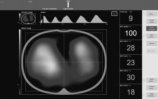 Bedside EIT screen