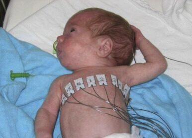 Electrode placement on a preterm infant